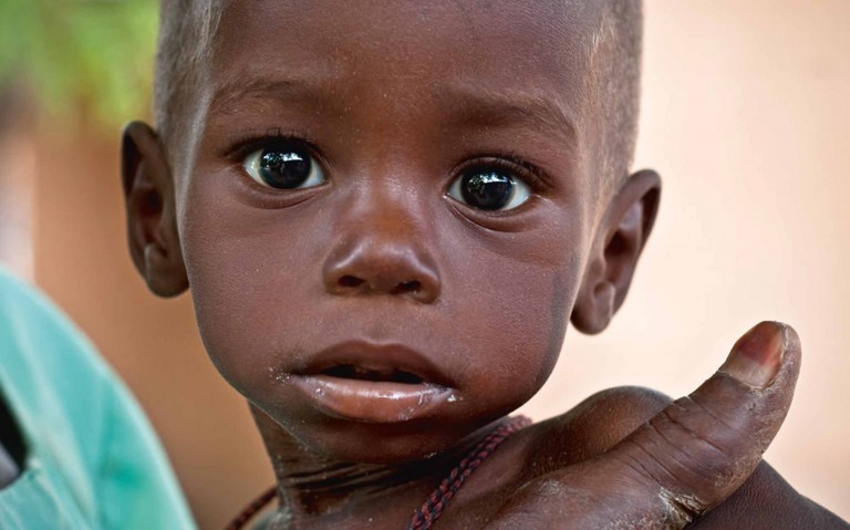 Odisha fall prey to malnutrition