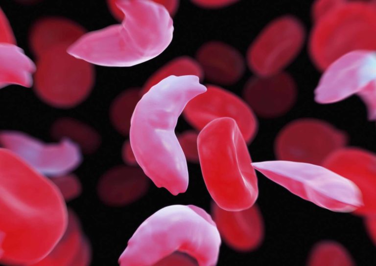 What You Should Know About Sickle Cell Disease