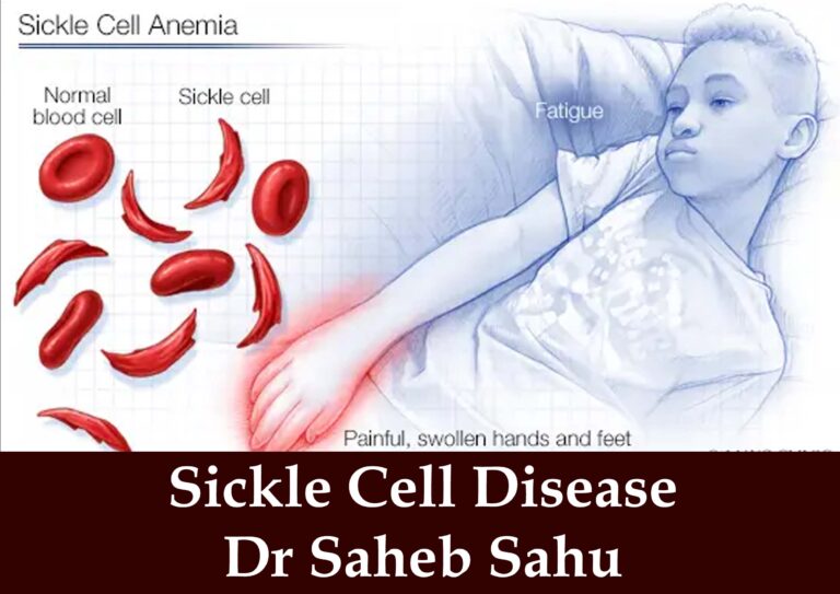 Sickle Cell Disease